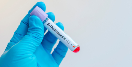 Doentes de beta-talassemia sob terapia génica mostram não dependência sustentada de transfusões sanguíneas e melhorias na qualidade de vida