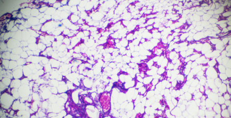 53 % dos doentes com linfoma folicular tratados com axicabtagene ciloleucel permanecem em resposta numa análise aos três anos