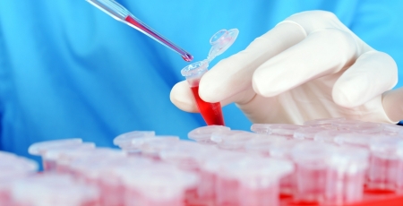 Linfoma folicular: obinutuzumab aumenta sobrevivência livre de progressão