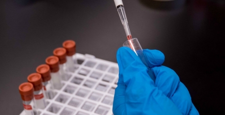 Transplantação com sangue do cordão umbilical expandido com bons resultados em doentes oncológicos